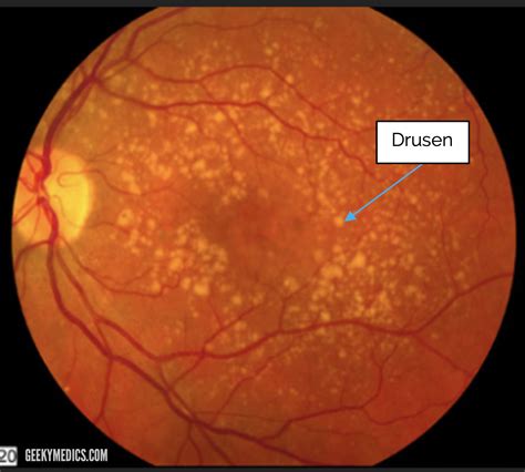 Drusen .